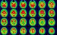 Scintigraphie cérébrale au HMPAO en faveur d'une maladie d'Alzheimer