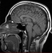Exemple d’une IRM cérébrale normale en coupe sagittale