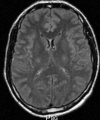 Exemple d’une IRM cérébrale normale en coupe axiale